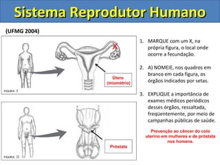 Sistema Reprodutor HumanoSistema Reprodutor Humano
(UFMG 2004)
1. MARQUE com um X, na
própria figura, o local onde
ocorre a fecundação.
2. A) NOMEIE, nos quadros em
branco em cada figura, os
órgãos indicados por setas.
3. EXPLIQUE a importância de
exames médicos periódicos
desses órgãos, ressaltada,
freqüentemente, por meio de
campanhas públicas de saúde.
X
Útero
(miométrio)
Próstata
Prevenção ao câncer do colo
uterino em mulheres e de próstata
nos homens.
 