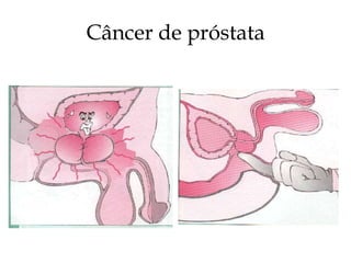 Câncer de próstata
 