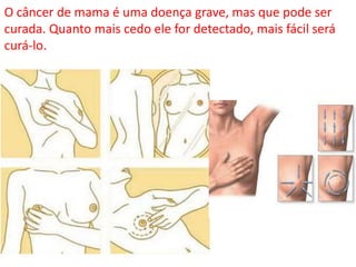 O câncer de mama é uma doença grave, mas que pode ser
curada. Quanto mais cedo ele for detectado, mais fácil será
curá-lo.
 