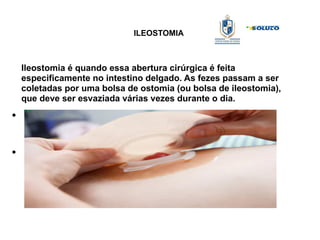 ILEOSTOMIA
Ileostomia é quando essa abertura cirúrgica é feita
especificamente no intestino delgado. As fezes passam a ser
coletadas por uma bolsa de ostomia (ou bolsa de ileostomia),
que deve ser esvaziada várias vezes durante o dia.
●
●
 