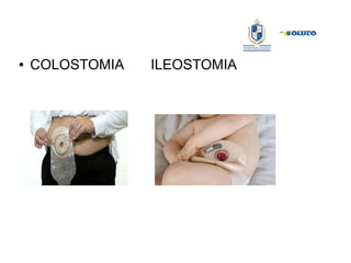 ● COLOSTOMIA ILEOSTOMIA
 