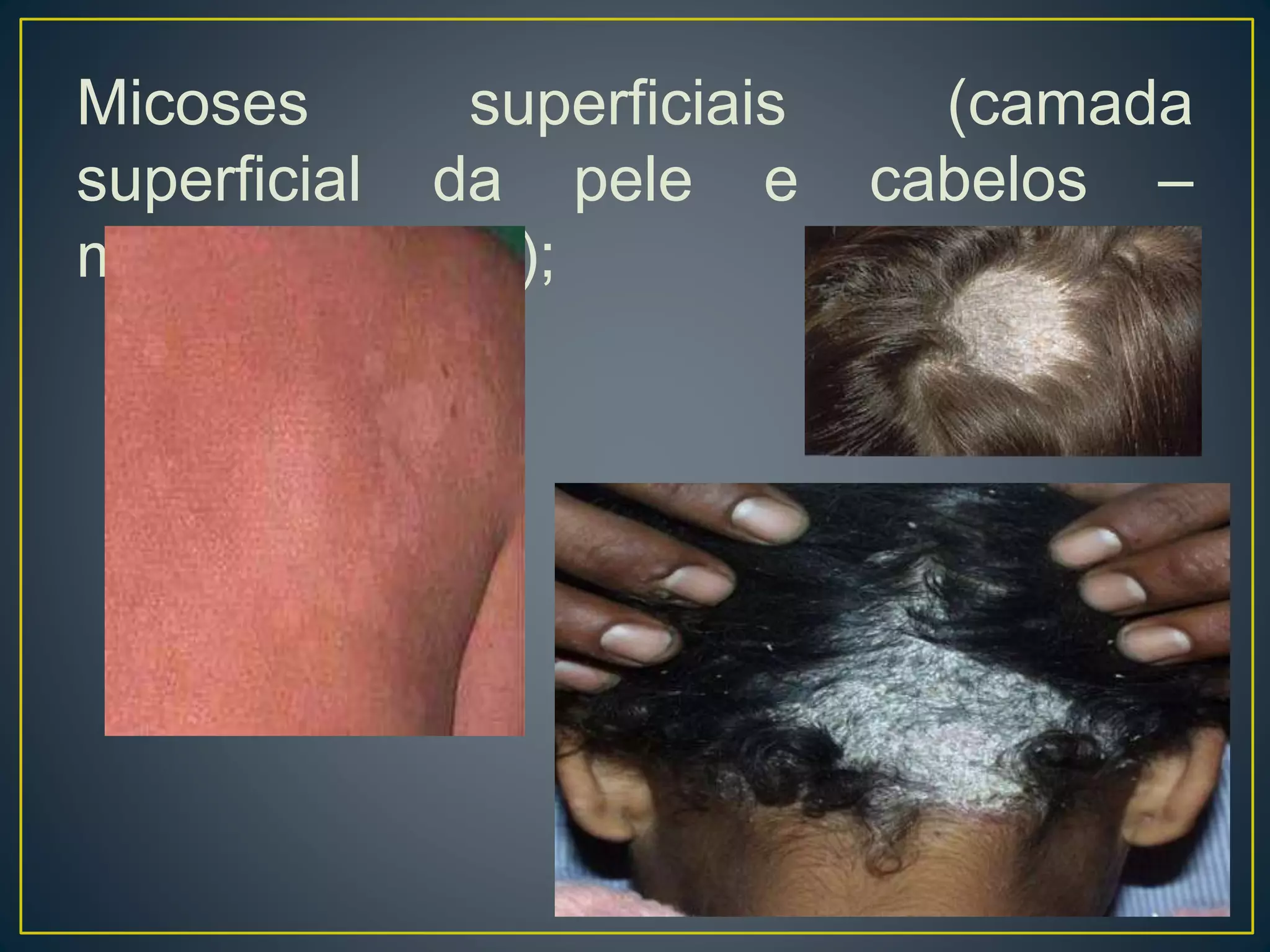Micoses superficiais (camada
superficial da pele e cabelos –
microbiota local);
 