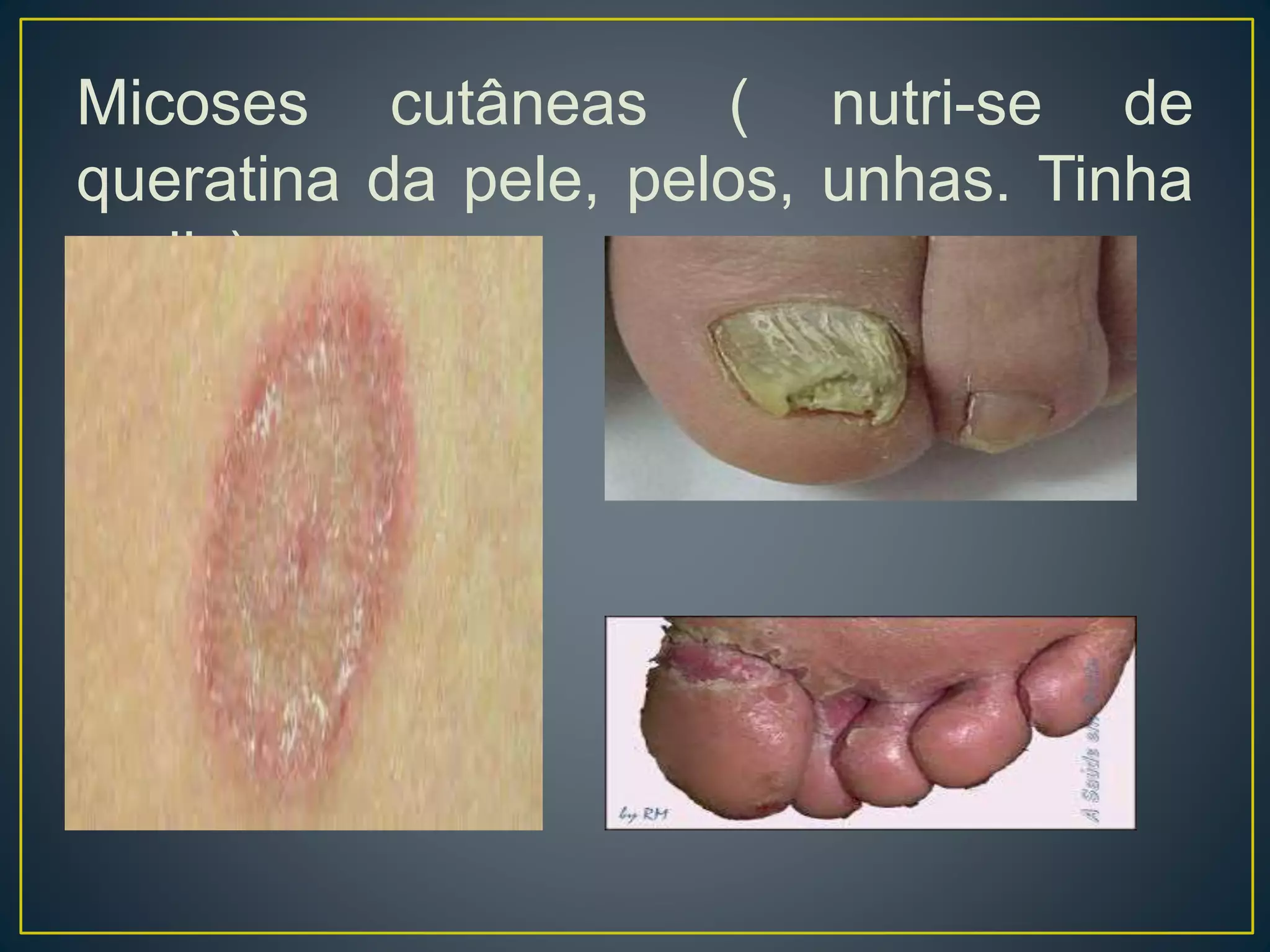 Micoses cutâneas ( nutri-se de
queratina da pele, pelos, unhas. Tinha
pedis).
 