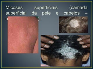Micoses superficiais (camada
superficial da pele e cabelos –
microbiota local);
 