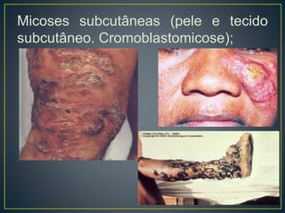 Micoses subcutâneas (pele e tecido
subcutâneo. Cromoblastomicose);
 