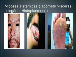 Micoses sistêmicas ( acomete vísceras
e órgãos. Histoplasmose).
 