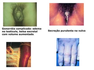 Gonorréia complicada: edema
no testículo, bolsa escrotal
com volume aumentado.
Secreção purulenta na vulva
 