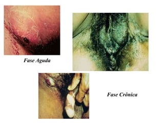 Fase Aguda
Fase Crônica
 