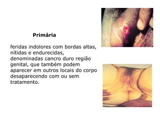 Primária
feridas indolores com bordas altas,
nítidas e endurecidas,
denominadas cancro duro região
genital, que também podem
aparecer em outros locais do corpo
desaparecendo com ou sem
tratamento.
 