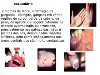 secundária
sintomas de febre, inflamação da
garganta - faringite, gânglios em várias
regiões do corpo, perda de cabelo, de
peso, de apetite e erupções cutâneas de
aspecto avermelhado ou arroxeado,
principalmente nas palmas das mãos e
plantas dos pés, denominadas roséolas
sifilíticas, bem como lesões úmidas nas
áreas genitais que são muito contagiosas.
 