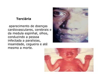 Terciária
aparecimento de doenças
cardiovasculares, cerebrais e
da medula espinhal, olhos,
conduzindo a pessoa
infectada a paralisias,
insanidade, cegueira e até
mesmo a morte.
 