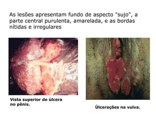 Vista superior de úlcera
no pênis.
As lesões apresentam fundo de aspecto "sujo", a
parte central purulenta, amarelada, e as bordas
nítidas e irregulares
Úlcerações na vulva.
 