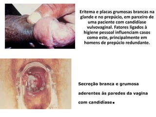 Secreção branca e grumosa
aderentes às paredes da vagina
com candidíase.
Eritema e placas grumosas brancas na
glande e no prepúcio, em parceiro de
uma paciente com candidíase
vulvovaginal. Fatores ligados à
higiene pessoal influenciam casos
como este, principalmente em
homens de prepúcio redundante.
 