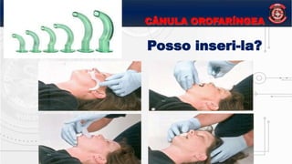 CÂNULA OROFARÍNGEA
Posso inseri-la?
 