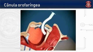 Cânula orofaríngea
 