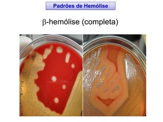 -hemólise (completa)
Padrões de Hemólise
 
