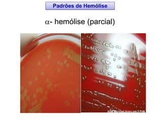 - hemólise (parcial)
Padrões de Hemólise
 