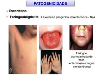 Escarlatina
 Faringoamigdalite  Exotoxina pirogênica estreptocócica - Spe
PATOGENICIDADE
Faringite,
acompanhada de
“rash”
eritematoso e língua
em framboesa
 