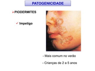 PIODERMITES
 Impetigo
- Mais comum no verão
- Crianças de 2 a 5 anos
PATOGENICIDADE
 