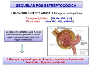GLOMERULONEFRITE AGUDA  linhagens nefritogênicas
Faringoamigdalites (M1, M4, M12, M15)
Piodermites (M49, M52, M55, M59-M61)
Excesso de complexos Ag-Ac nas
membranas dos glomérulos renais,
ativa o complemento e gera uma
reação inflamatória.
Inflamação aguda do glomérulo renal, com edema, hipertensão,
hemáturia, oligúria e proteinúria
SEQUELAS PÓS ESTREPTOCÓCICA
 