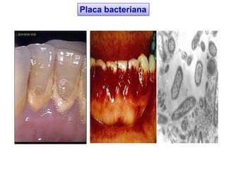 Placa bacteriana
 