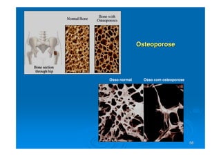 58
58
Osteoporose
Osteoporose
Osso normal Osso com osteoporose
 
