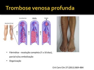 • Fibrinólise - resolução completa (7 a 10 dias),
parcial e/ou embolização
• Organização
Crit Care Clin 27 (2011) 869–884

 