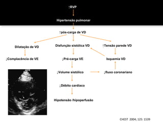 ↑RVP

Hipertensão pulmonar

↑pós-carga de VD

Dilatação de VD

↓Complacência de VE

Disfunção sistólica VD

↓Pré-carga VE

↓Volume sistólico

↑Tensão parede VD

Isquemia VD

↓fluxo coronariano

↓Débito cardíaco

Hipotensão /hipoperfusão

CHEST 2004; 125: 1539

 