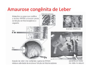 Amaurose congênita de Leber
 
