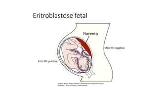 Eritroblastose fetal
Mãe Rh negativo
Feto Rh positivo
Ciências, 8° ano do Ensino Fundamental
Sistema ABO e Fator RH
Imagem: Autor Magnus Manske / retrabalhado e disponibilizado por
Amada44 / Gray's Anatomy / Public domain.
 