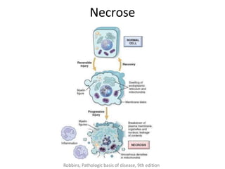 Necrose
Robbins, Pathologic basis of disease, 9th edition
 