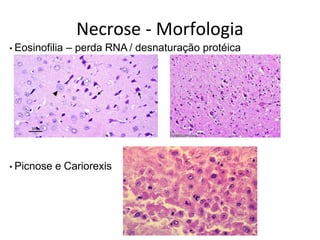 Necrose - Morfologia
• Eosinofilia – perda RNA / desnaturação protéica
• Picnose e Cariorexis
 