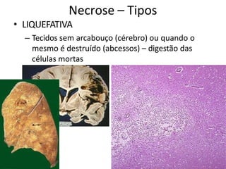Necrose – Tipos
• LIQUEFATIVA
– Tecidos sem arcabouço (cérebro) ou quando o
mesmo é destruído (abcessos) – digestão das
células mortas
 