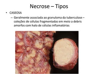 Necrose – Tipos
• CASEOSA
– Geralmente associada ao granuloma da tuberculose –
coleções de células fragmentadas em meio a debris
amorfos com halo de células inflamatórias
 
