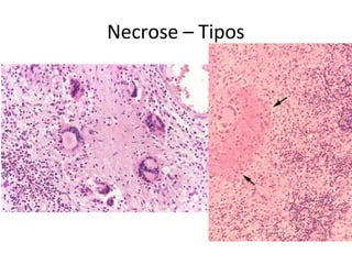 Necrose – Tipos
 