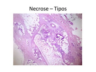 Necrose – Tipos
 
