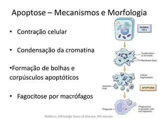 Apoptose – Mecanismos e Morfologia
• Contração celular
• Condensação da cromatina
•Formação de bolhas e
corpúsculos apoptóticos
• Fagocitose por macrófagos
Robbins, Pathologic basis of disease, 9th edition
 