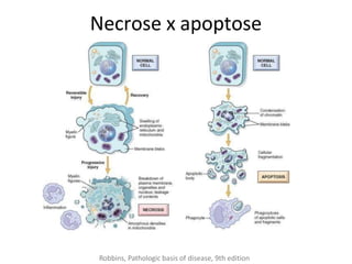 Necrose x apoptose
Robbins, Pathologic basis of disease, 9th edition
 
