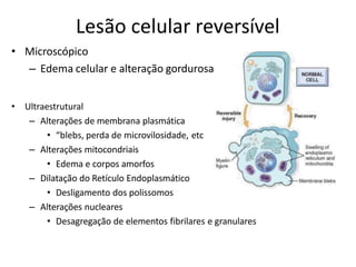 Lesão celular reversível
• Microscópico
– Edema celular e alteração gordurosa
• Ultraestrutural
– Alterações de membrana plasmática
• “blebs, perda de microvilosidade, etc
– Alterações mitocondriais
• Edema e corpos amorfos
– Dilatação do Retículo Endoplasmático
• Desligamento dos polissomos
– Alterações nucleares
• Desagregação de elementos fibrilares e granulares
 