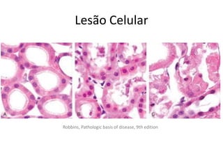 Lesão Celular
Robbins, Pathologic basis of disease, 9th edition
 