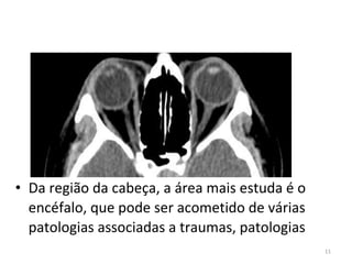 11
• Da região da cabeça, a área mais estuda é o
encéfalo, que pode ser acometido de várias
patologias associadas a traumas, patologias
 