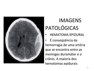 23
IMAGENS
PATOLÓGICAS
• HEMATOMA EPIDURAL
• É conseqüência da
hemorragia de uma artéria
que se encontra entre as
meninges duramáter e o
crânio. A maioria dos
hematomas epidurais
 