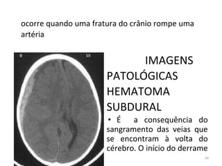 24
ocorre quando uma fratura do crânio rompe uma
artéria
IMAGENS
PATOLÓGICAS
HEMATOMA
SUBDURAL
• É a consequência do
sangramento das veias que
se encontram à volta do
cérebro. O início do derrame
 