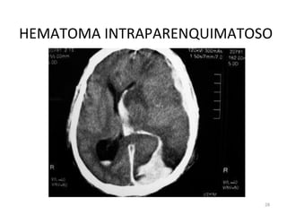 28
HEMATOMA INTRAPARENQUIMATOSO
 