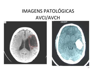 29
IMAGENS PATOLÓGICAS
AVCI/AVCH
 