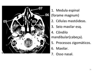 30
1. Medula espinal
(forame magnum)
2. Células mastóideas.
3. Seio maxilar esq.
4. Côndilo
mandibular(cabeça).
5. Processos zigomáticos.
6. Maxilar.
7. Osso nasal.
 