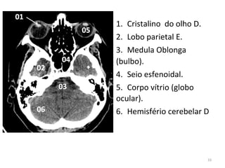 33
1. Cristalino do olho D.
2. Lobo parietal E.
3. Medula Oblonga
(bulbo).
4. Seio esfenoidal.
5. Corpo vítrio (globo
ocular).
6. Hemisfério cerebelar D
 