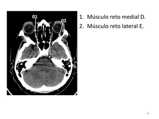 34
1. Músculo reto medial D.
2. Músculo reto lateral E.
 