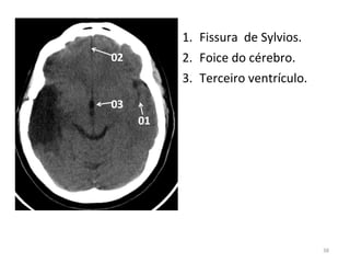 38
1. Fissura de Sylvios.
2. Foice do cérebro.
3. Terceiro ventrículo.
 