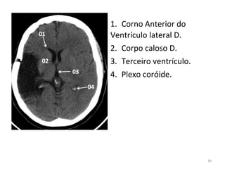 39
1. Corno Anterior do
Ventrículo lateral D.
2. Corpo caloso D.
3. Terceiro ventrículo.
4. Plexo coróide.
 